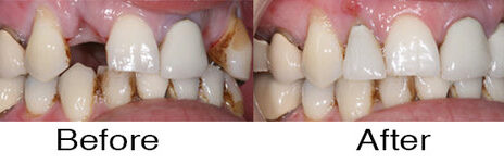 Dental Implants 1