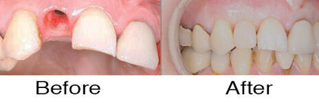Dental Implants 2