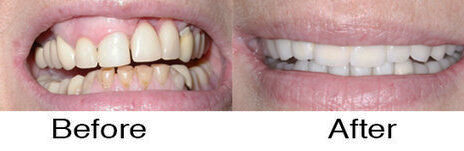 Dental Implants 3