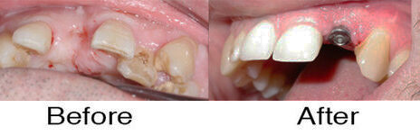 Dental Implants 4
