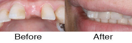 Dental Implants 5