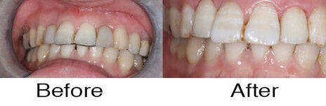 Dental Implants 6