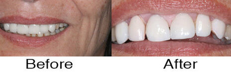 Veneers 6