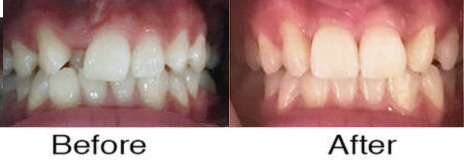 Invisalign® 6